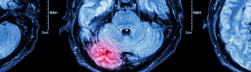 MRI of an injured brain