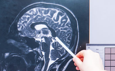 Can Your Personality Change after a Traumatic Brain Injury?