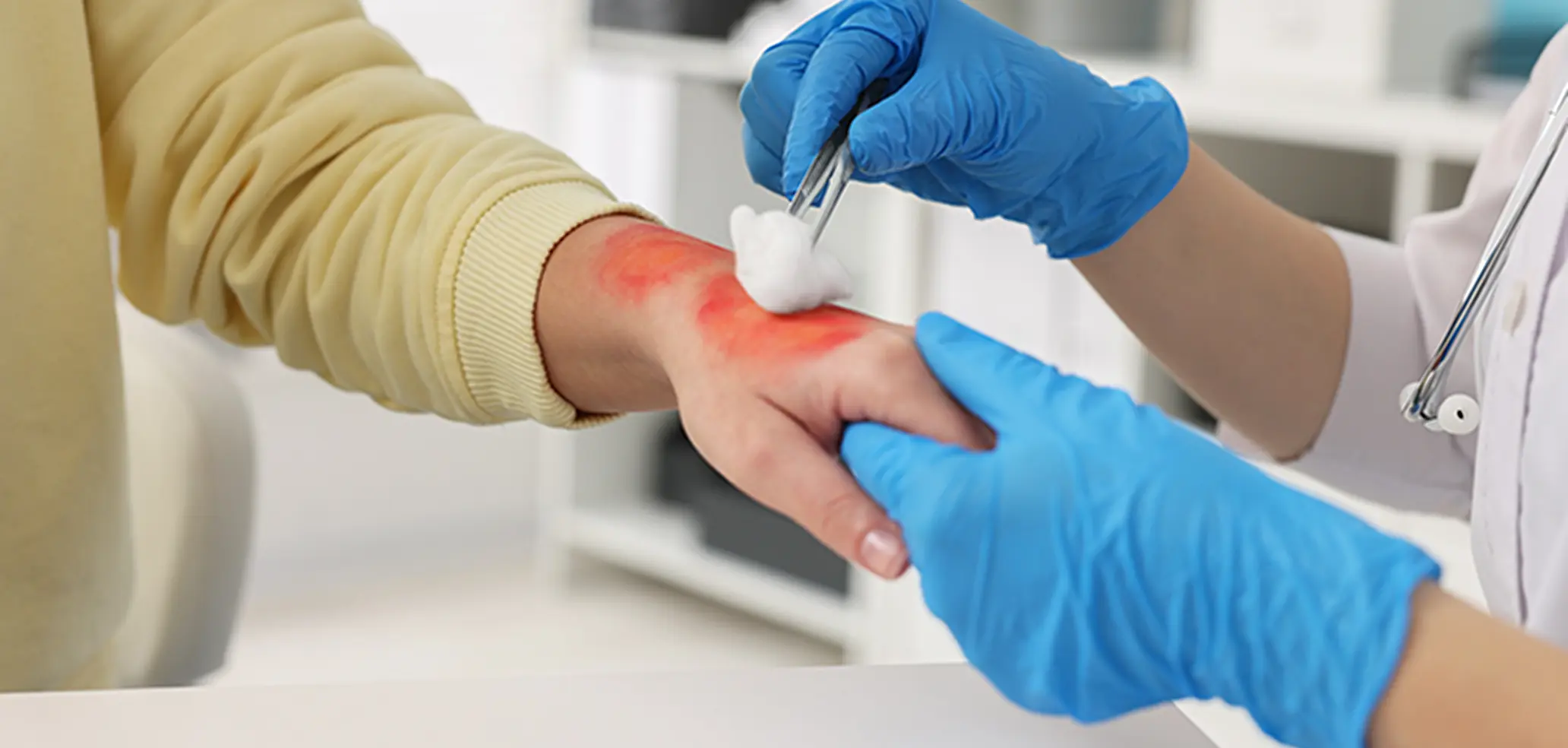 burn injury - J. G. Winter Law